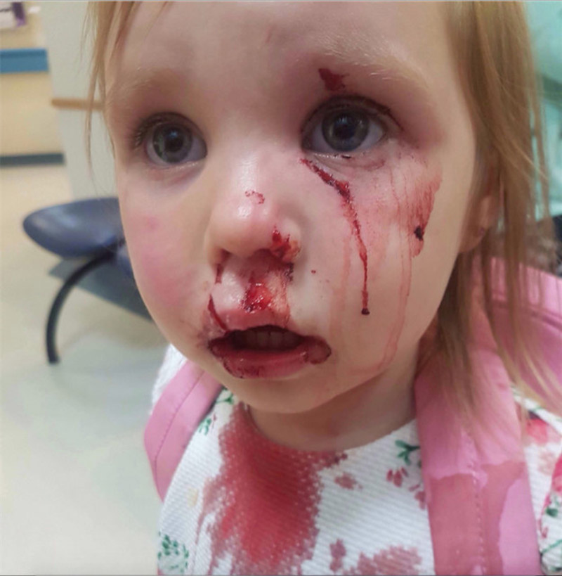 Main image for Girl scarred following dog attack